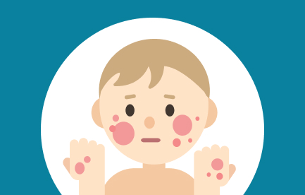 Course Image Pediatric Atopic Dermatitis Online Education